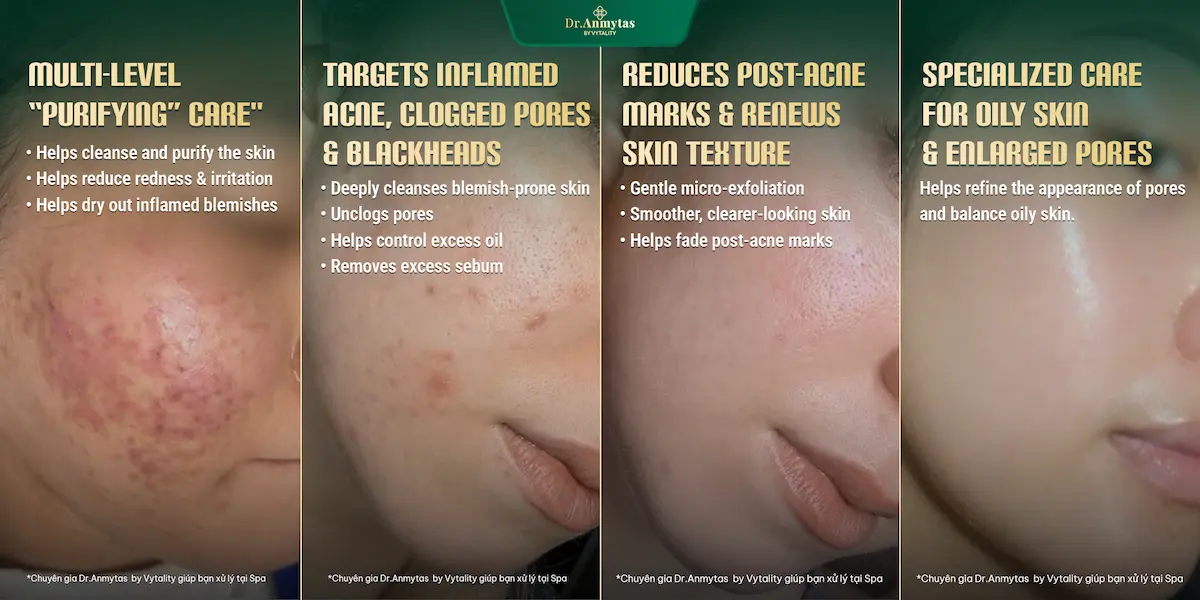 Dr.Anmytas multi-level acne care — purifying, targeting inflamed acne, reducing post-acne marks, and specialized care for oily skin