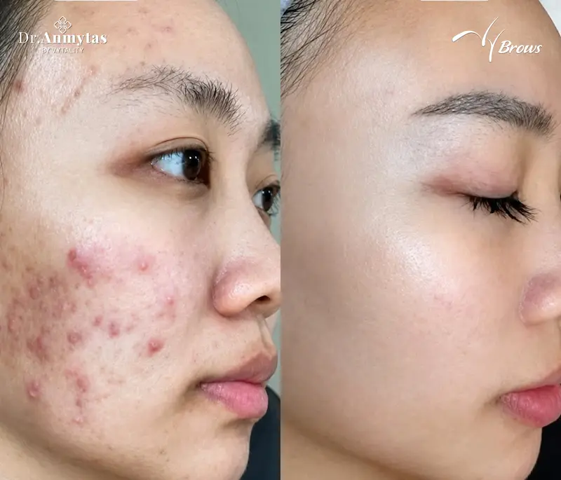 Before and after full-face inflammatory acne treatment at VyBrows