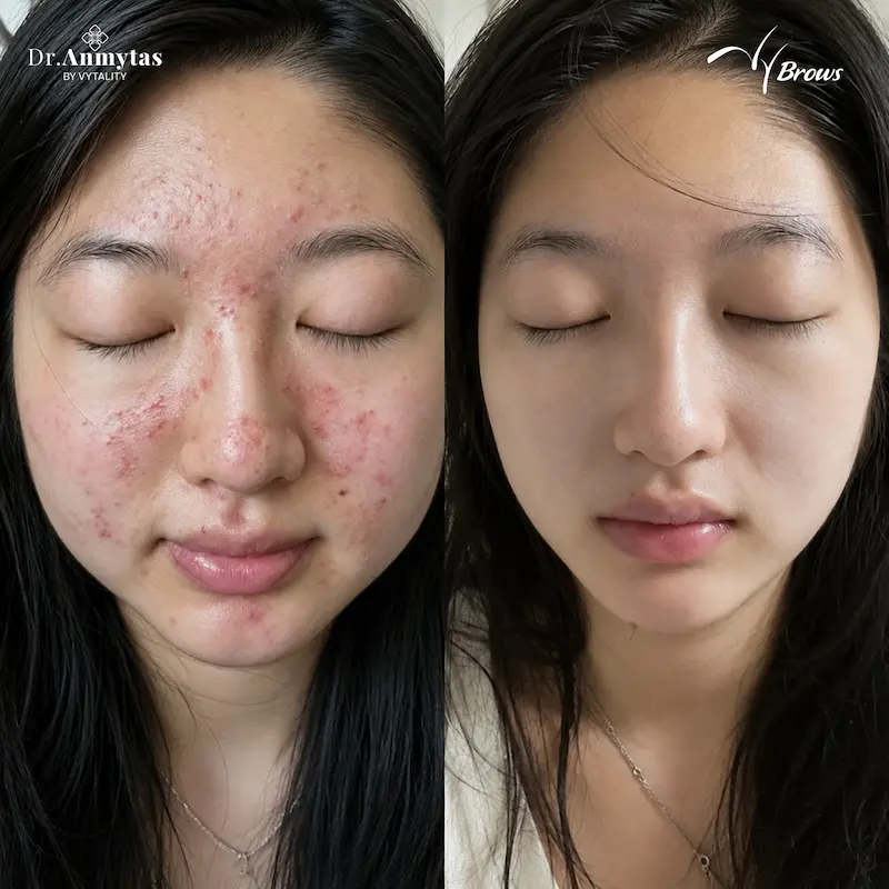 Real acne treatment result at VyBrows — before and after