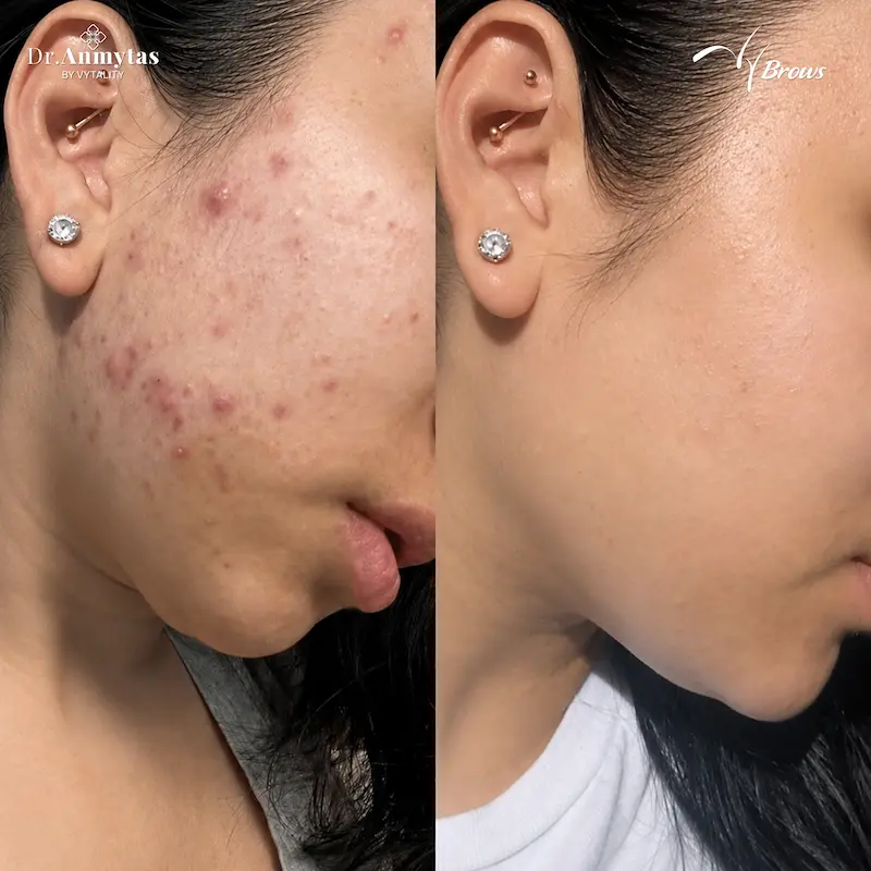 Before and after temple-area acne treatment at VyBrows