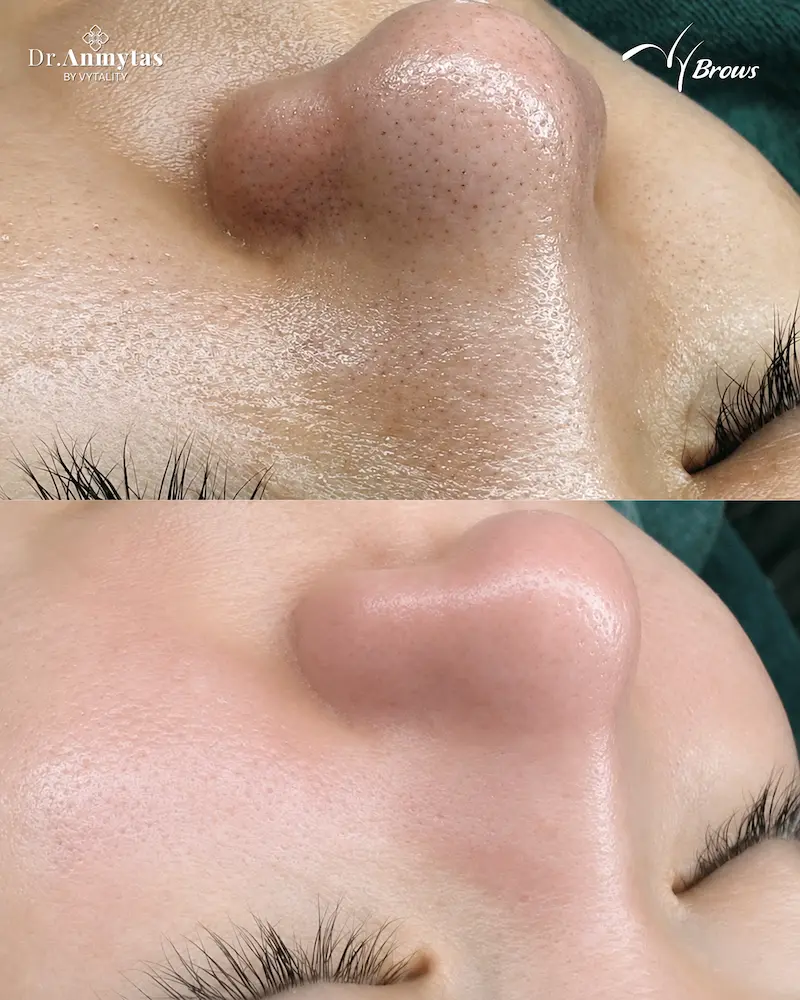 Real blackhead extraction result at VyBrows — before and after