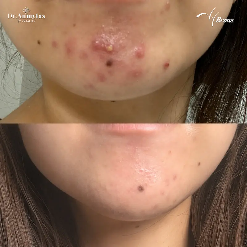 Before and after chin acne treatment at VyBrows