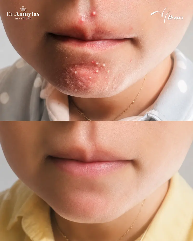 Before and after mouth-and-chin acne treatment at VyBrows
