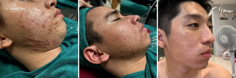 Real acne treatment session at VyBrows