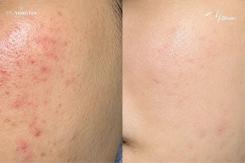 Before and after cheek-area acne treatment at VyBrows