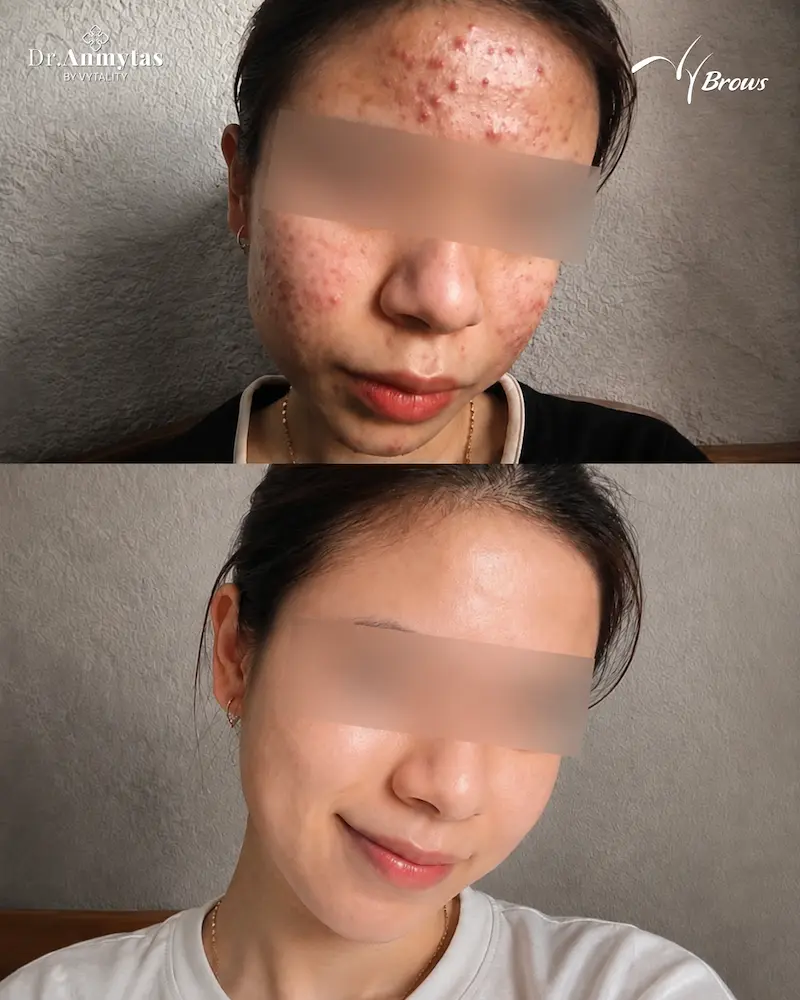 Real acne treatment result at VyBrows — before and after